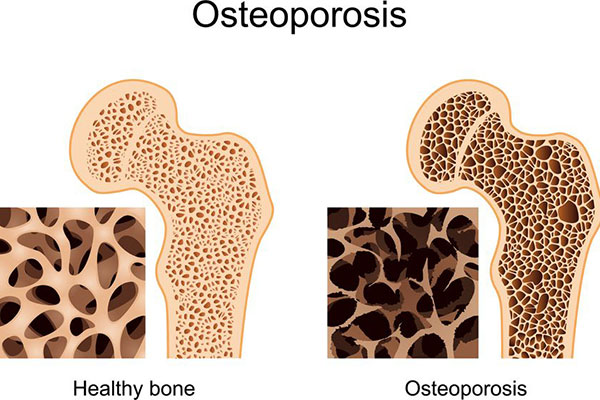 Se puede trabajar con osteoporosis